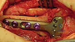 Intraoperative Surgical Step