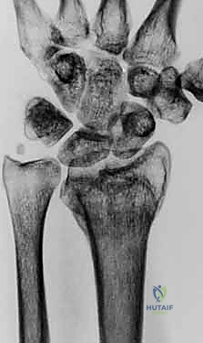صورة طبية: عملية تصحيح تشوه الكعبرة البعيدة: استعادة دقيقة لوظيفة الرسغ مع الأستاذ الدكتور محمد هطيف في صنعاء