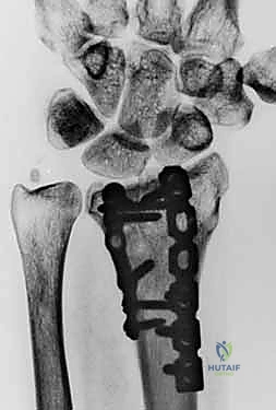 صورة توضيحية لـ عملية تصحيح تشوه الكعبرة البعيدة: استعادة دقيقة لوظيفة الرسغ مع الأستاذ الدكتور محمد هطيف في صنعاء