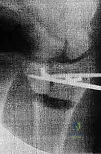 صورة توضيحية لـ عملية تصحيح تشوه الكعبرة البعيدة: استعادة دقيقة لوظيفة الرسغ مع الأستاذ الدكتور محمد هطيف في صنعاء