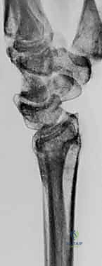 صورة طبية: عملية تصحيح تشوه الكعبرة البعيدة: استعادة دقيقة لوظيفة الرسغ مع الأستاذ الدكتور محمد هطيف في صنعاء