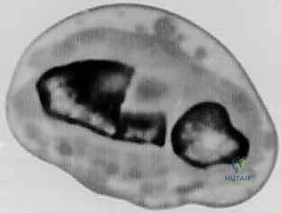 صورة طبية: عملية تصحيح تشوه الكعبرة البعيدة: استعادة دقيقة لوظيفة الرسغ مع الأستاذ الدكتور محمد هطيف في صنعاء