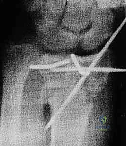 صورة طبية: عملية تصحيح تشوه الكعبرة البعيدة: استعادة دقيقة لوظيفة الرسغ مع الأستاذ الدكتور محمد هطيف في صنعاء