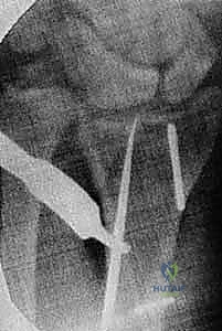 Illustration of distal radius malunion - Dr. Mohammed Hutaif