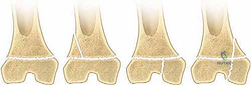 تصنيف سالتر هاريس للكسور