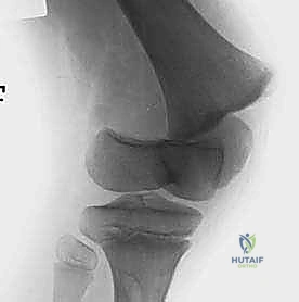 صورة توضيحية لـ كسور صفيحة النمو الفخذية البعيدة عند الأطفال: دليل شامل للعلاج مع الأستاذ الدكتور محمد هطيف في صنعاء