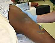 تشريح الركبة وصفيحة النمو