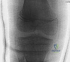 كسور صفيحة النمو الفخذية البعيدة عند الأطفال: دليل شامل للعلاج مع الأستاذ الدكتور محمد هطيف في صنعاء