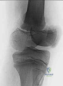 صورة توضيحية لـ كسور صفيحة النمو الفخذية البعيدة عند الأطفال: دليل شامل للعلاج مع الأستاذ الدكتور محمد هطيف في صنعاء