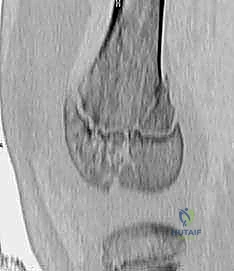 صورة توضيحية لـ كسور صفيحة النمو الفخذية البعيدة عند الأطفال: دليل شامل للعلاج مع الأستاذ الدكتور محمد هطيف في صنعاء