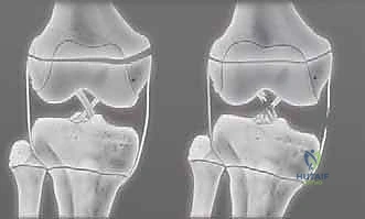التثبيت الداخلي باستخدام البراغي والأسلاك