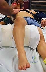 آلية حدوث الكسر الفخذي