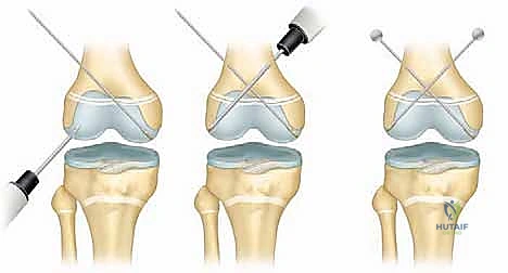 النوع الثالث والرابع من الكسور