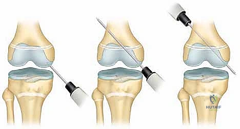 النوع الأول والثاني من الكسور