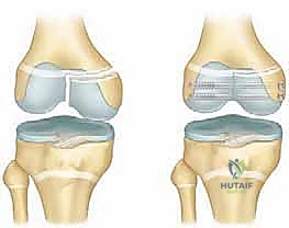Illustration of distal femoral physeal - Dr. Mohammed Hutaif