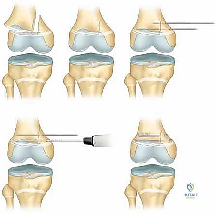 التثبيت بالجبس للكسور البسيطة