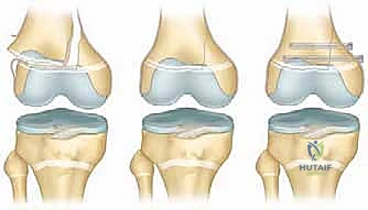 التخطيط الجراحي الدقيق