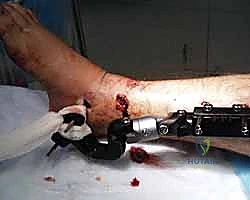 صورة توضيحية لـ التثبيت الخارجي لعظم الساق