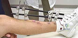 أهمية التثبيت الخارجي في الكسور المفتوحة