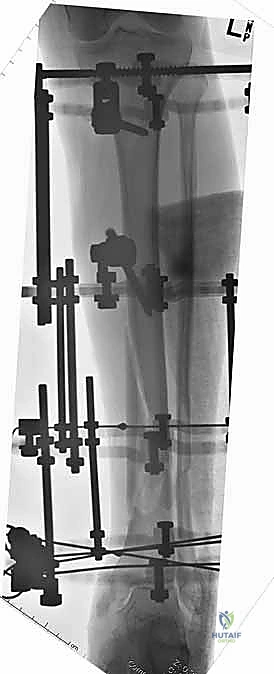 التخطيط الجراحي لكسور الساق