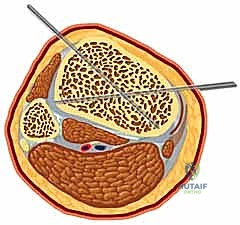 آلية عمل المثبت الخارجي