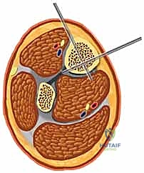 الأستاذ الدكتور محمد هطيف في غرفة العمليات