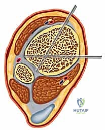 مقارنة بين طرق التثبيت