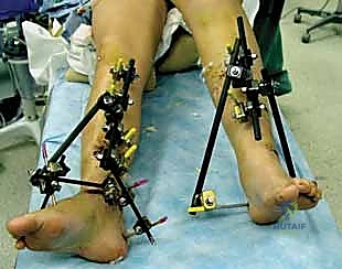 إحكام ربط المشابك