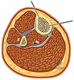 أدوات التثبيت الجراحي