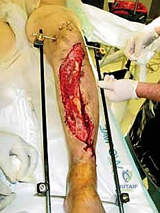 تثبيت الدبابيس في العظم