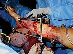 عملية رد الكسر