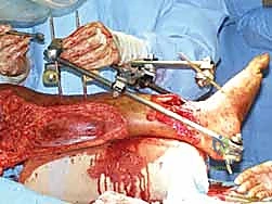 صورة طبية: التثبيت الخارجي لعظم الساق: دليل شامل للمرضى مع الأستاذ الدكتور محمد هطيف