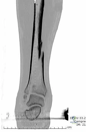 صورة طبية: التثبيت الخارجي لعظم الساق: دليل شامل للمرضى مع الأستاذ الدكتور محمد هطيف