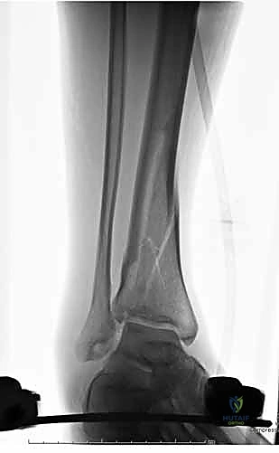 صور الأشعة المقطعية للكسر