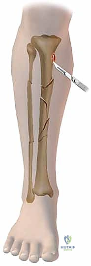 أنواع المثبتات الخارجية