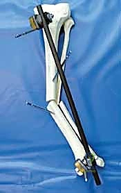 صورة توضيحية لـ التثبيت الخارجي لعظم الساق: دليل شامل للمرضى مع الأستاذ الدكتور محمد هطيف