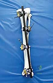 تشريح عظم الساق والكسور المعقدة