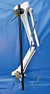 صورة توضيحية لـ التثبيت الخارجي لعظم الساق: دليل شامل للمرضى مع الأستاذ الدكتور محمد هطيف