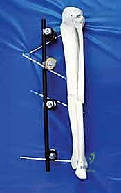 صورة توضيحية لـ التثبيت الخارجي لعظم الساق: دليل شامل للمرضى مع الأستاذ الدكتور محمد هطيف