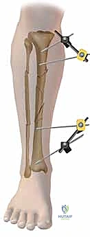 صورة طبية: التثبيت الخارجي لعظم الساق: دليل شامل للمرضى مع الأستاذ الدكتور محمد هطيف