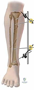 صورة توضيحية لـ التثبيت الخارجي لعظم الساق: دليل شامل للمرضى مع الأستاذ الدكتور محمد هطيف