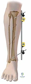 تركيب الإطار الخارجي