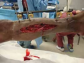 صورة توضيحية لـ التثبيت الخارجي لعظم الساق: دليل شامل للمرضى مع الأستاذ الدكتور محمد هطيف