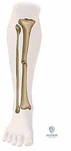 صورة طبية: التثبيت الخارجي لعظم الساق: دليل شامل للمرضى مع الأستاذ الدكتور محمد هطيف