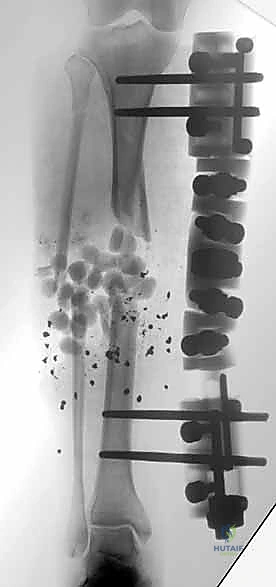 صورة طبية: التثبيت الخارجي لعظم الساق: دليل شامل للمرضى مع الأستاذ الدكتور محمد هطيف