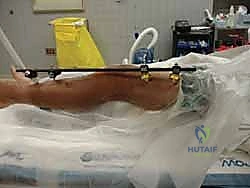 صورة طبية: التثبيت الخارجي لعظم الساق: دليل شامل للمرضى مع الأستاذ الدكتور محمد هطيف