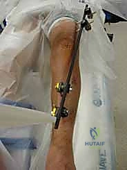 صورة طبية: التثبيت الخارجي لعظم الساق: دليل شامل للمرضى مع الأستاذ الدكتور محمد هطيف