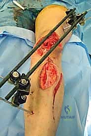Intraoperative Surgical Step