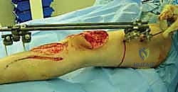 صورة طبية: التثبيت الخارجي لعظم الساق: دليل شامل للمرضى مع الأستاذ الدكتور محمد هطيف