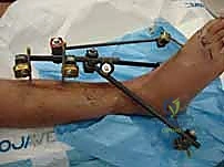 صورة طبية: التثبيت الخارجي لعظم الساق: دليل شامل للمرضى مع الأستاذ الدكتور محمد هطيف